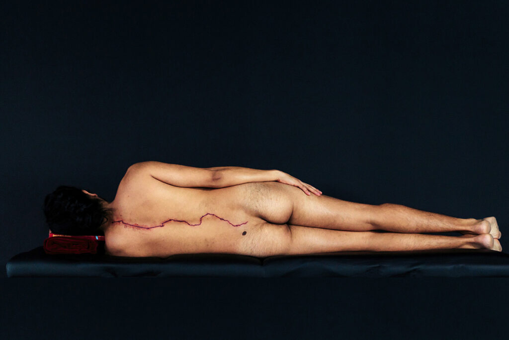 photo of man lying naked, back to camera, with long scar tracing down the center of his back